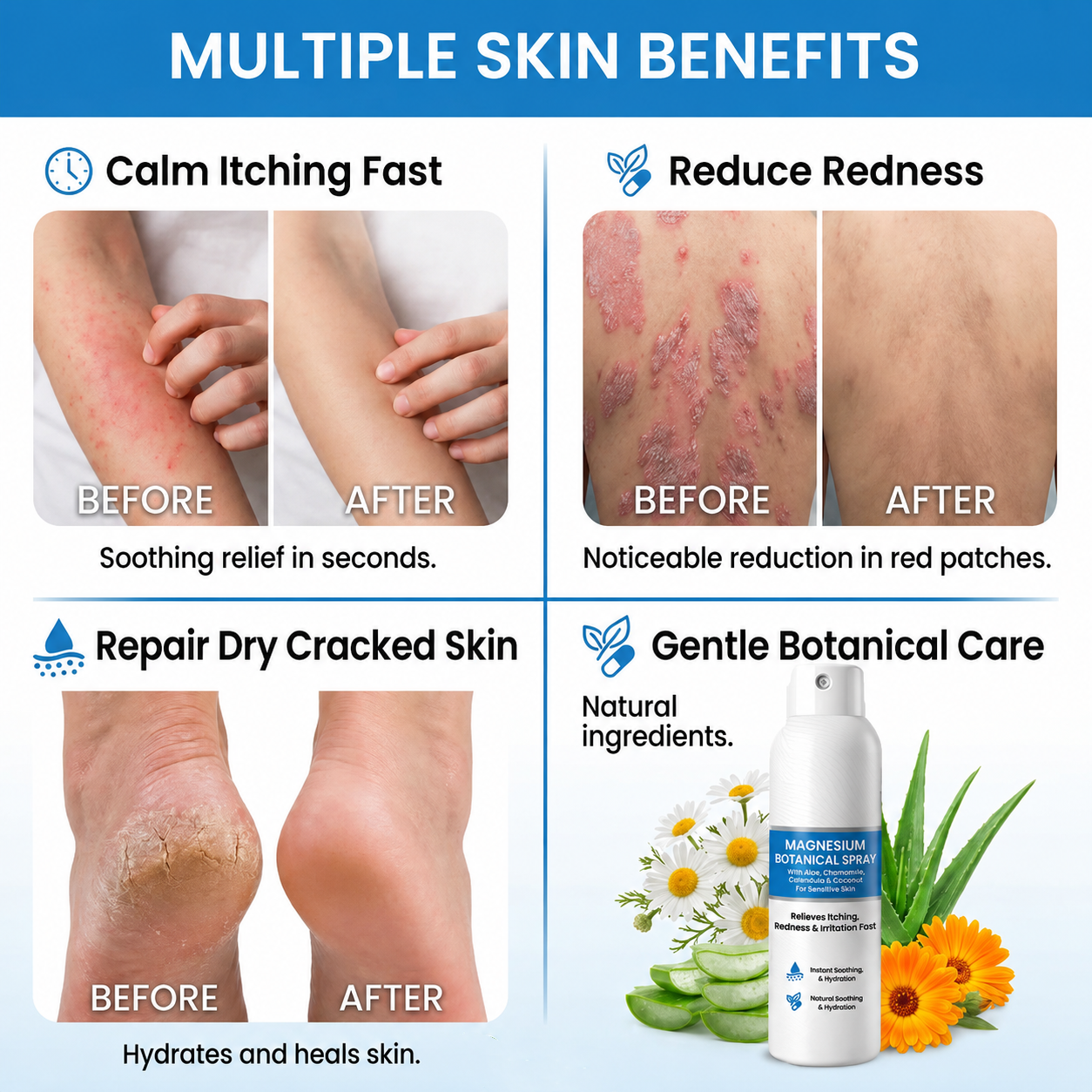 🔥Heroiy® Magnesium Botanical Spray – Advanced Skin Recovery for Psoriasis & Eczema | Rapid Soothing, Steroid-Free-YH