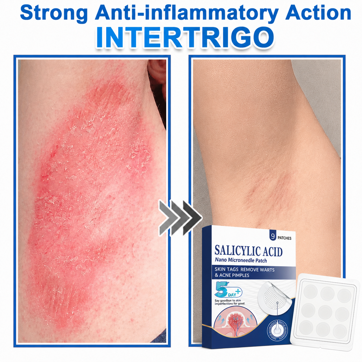🏆 Heroiy® 2-in-1 Microneedle & Hydrocolloid Patch | Raised Moles,Acne, Flat Warts & Skin Tags Remover | Improves Wrinkles, Scars & Blemishes | Invisible Pimple Patches for Face & Body-ANN