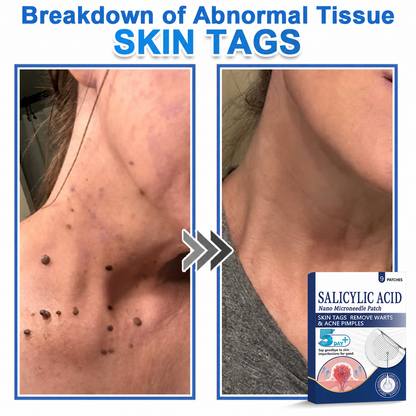 🏆 Heroiy® 2-in-1 Microneedle & Hydrocolloid Patch | Raised Moles,Acne, Flat Warts & Skin Tags Remover | Improves Wrinkles, Scars & Blemishes | Invisible Pimple Patches for Face & Body-ANN