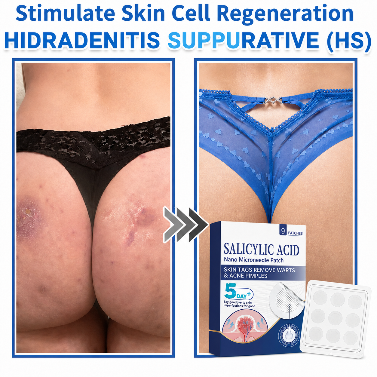 🏆 Heroiy® 2-in-1 Microneedle & Hydrocolloid Patch | Raised Moles,Acne, Flat Warts & Skin Tags Remover | Improves Wrinkles, Scars & Blemishes | Invisible Pimple Patches for Face & Body-ANN