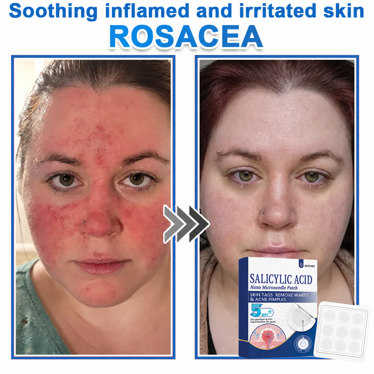 🏆 Heroiy® 2-in-1 Microneedle & Hydrocolloid Patch | Raised Moles,Acne, Flat Warts & Skin Tags Remover | Improves Wrinkles, Scars & Blemishes | Invisible Pimple Patches for Face & Body-ANN