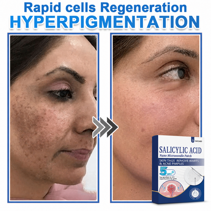🏆 Heroiy® 2-in-1 Microneedle & Hydrocolloid Patch | Raised Moles,Acne, Flat Warts & Skin Tags Remover | Improves Wrinkles, Scars & Blemishes | Invisible Pimple Patches for Face & Body-ANN