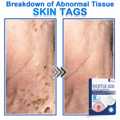 🏆 Heroiy® 2-in-1 Microneedle & Hydrocolloid Patch | Raised Moles,Acne, Flat Warts & Skin Tags Remover | Improves Wrinkles, Scars & Blemishes | Invisible Pimple Patches for Face & Body-ANN
