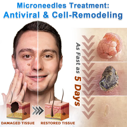 🏆 Heroiy® 2-in-1 Microneedle & Hydrocolloid Patch | Raised Moles,Acne, Flat Warts & Skin Tags Remover | Improves Wrinkles, Scars & Blemishes | Invisible Pimple Patches for Face & Body-ANN