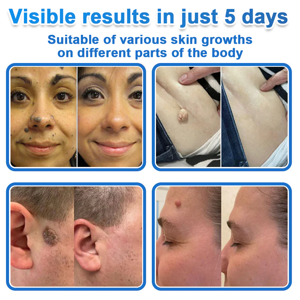 🏆 Heroiy® 2-in-1 Microneedle & Hydrocolloid Patch | Raised Moles,Acne, Flat Warts & Skin Tags Remover | Improves Wrinkles, Scars & Blemishes | Invisible Pimple Patches for Face & Body-ANN