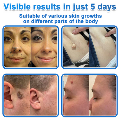 🏆 Heroiy® 2-in-1 Microneedle & Hydrocolloid Patch | Raised Moles,Acne, Flat Warts & Skin Tags Remover | Improves Wrinkles, Scars & Blemishes | Invisible Pimple Patches for Face & Body-ANN