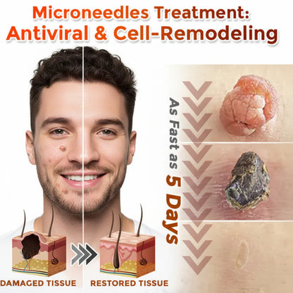 SKIN TAGS PATCHES MOLE & WART REMOVER-ZGD