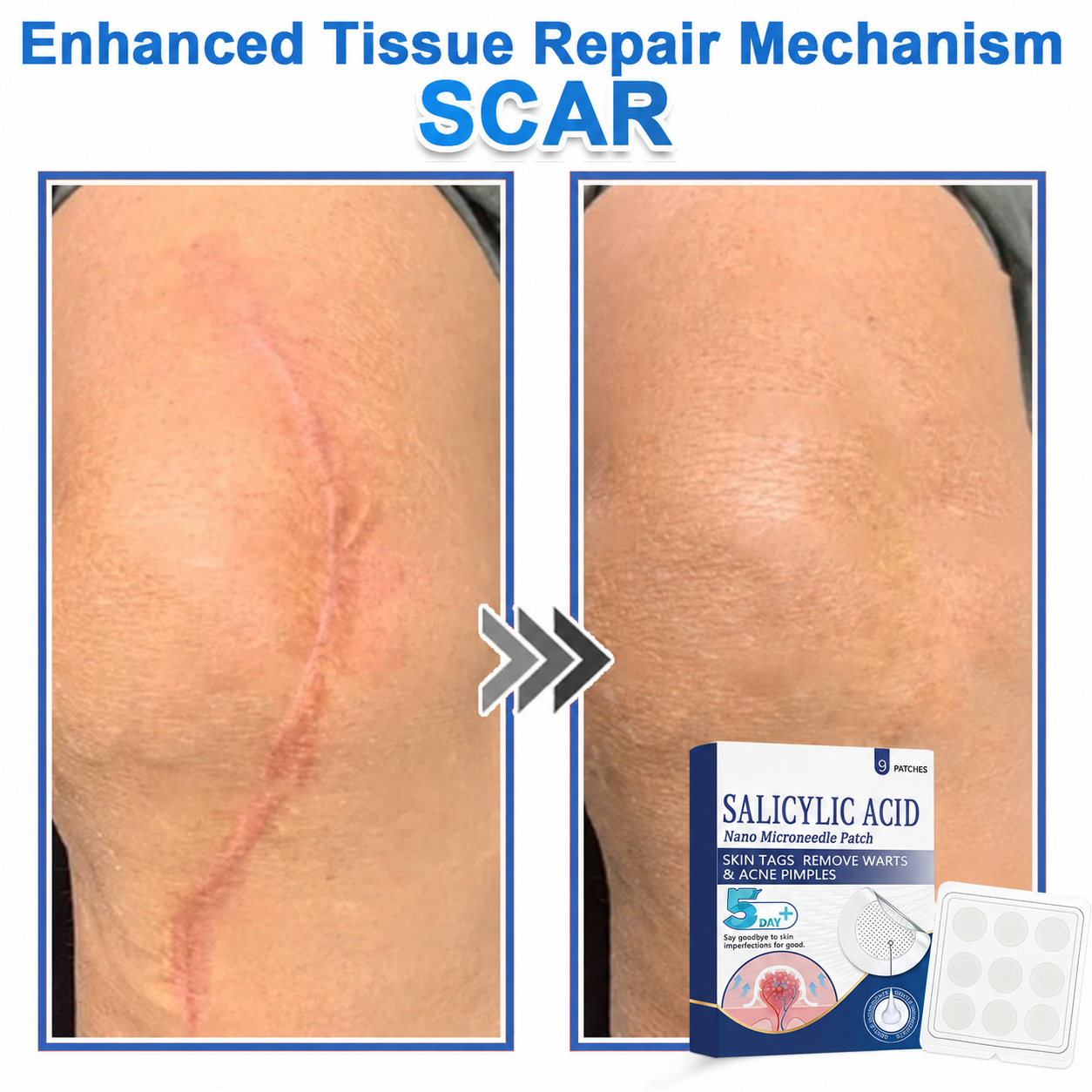🏆 Heroiy® 2-in-1 Microneedle & Hydrocolloid Patch | Raised Moles,Acne, Flat Warts & Skin Tags Remover | Improves Wrinkles, Scars & Blemishes | Invisible Pimple Patches for Face & Body-ANN