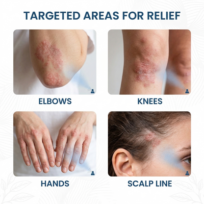 🔥Heroiy® Magnesium Botanical Spray – Advanced Skin Recovery for Psoriasis & Eczema | Rapid Soothing, Steroid-Free-YH