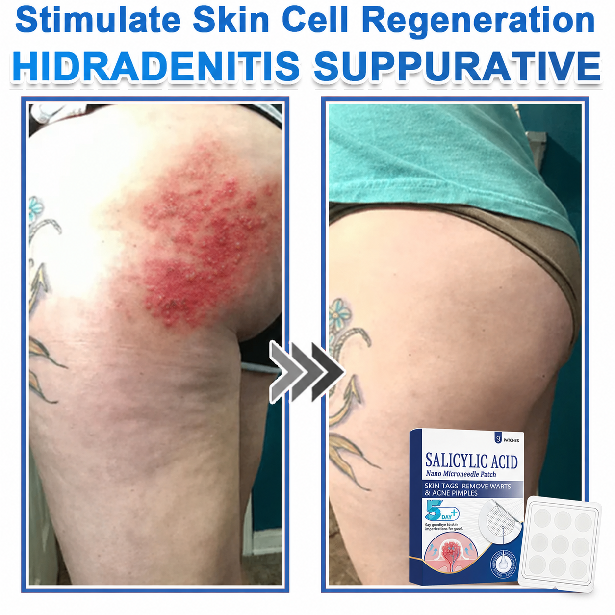🏆 Heroiy® 2-in-1 Microneedle & Hydrocolloid Patch | Raised Moles,Acne, Flat Warts & Skin Tags Remover | Improves Wrinkles, Scars & Blemishes | Invisible Pimple Patches for Face & Body-ANN