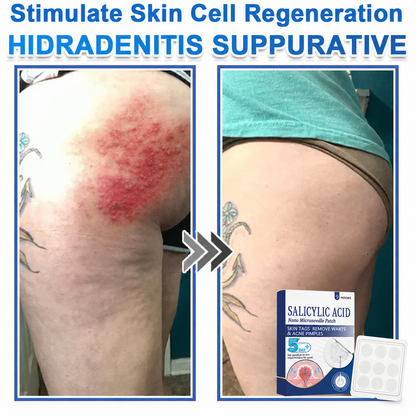 🏆 Heroiy® 2-in-1 Microneedle & Hydrocolloid Patch | Raised Moles,Acne, Flat Warts & Skin Tags Remover | Improves Wrinkles, Scars & Blemishes | Invisible Pimple Patches for Face & Body-ANN