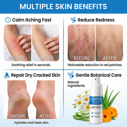 🔥Heroiy® Magnesium Botanical Spray – Advanced Skin Recovery for Psoriasis & Eczema | Rapid Soothing, Steroid-Free-YH