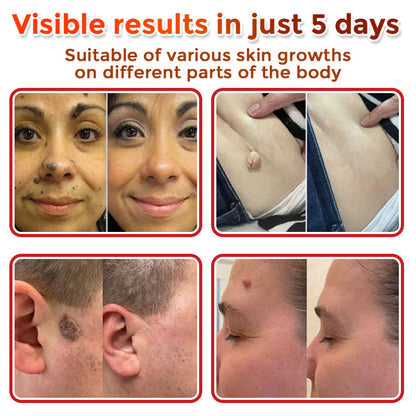 SKIN TAGS PATCHES MOLE & WART REMOVER-ZGD