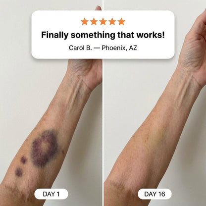 💥75K+ SOLD💕- Heroiy® Bruise Repair & Skin-Strengthening Cream-YH