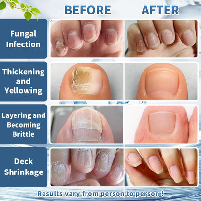 3-Day Maximum Intensity Nail Fungus Treatment - Fast-Acting Liquid Drops-ANN